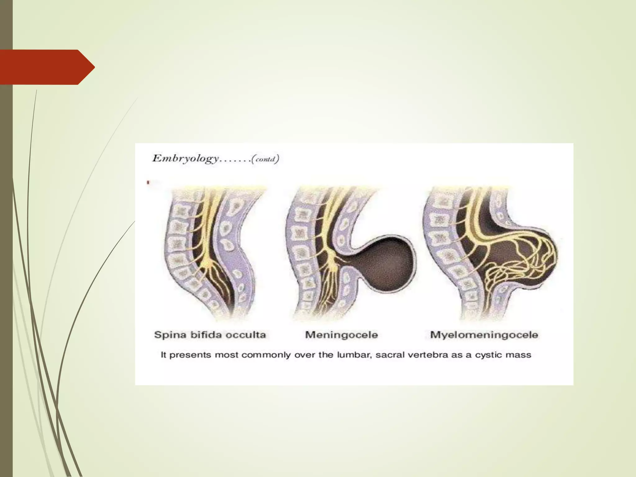 anaesthetic management of Meningomyelocele and its Surgical excision | PPTX