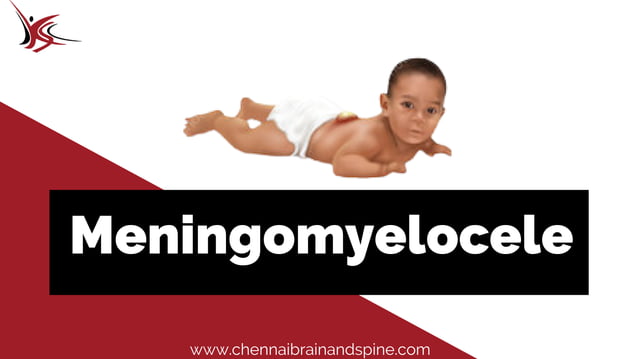 Meningomyelocele | PDF | Brain and Nervous System Disorders | Diseases ...