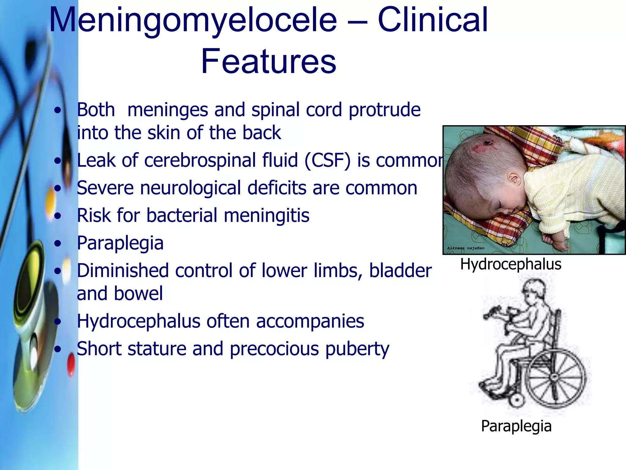 Meningomyelocoele | PPT