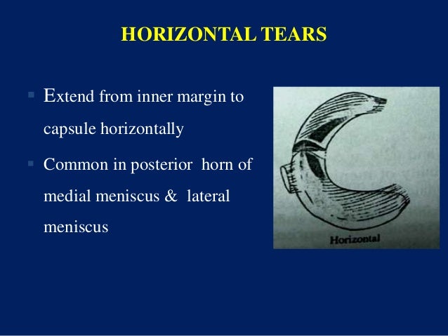 Meniscal Injuries