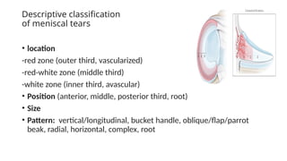 Meniscal injuries & Discoid meniscus (2024).pptx