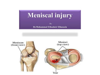 Meniscal injury 
By 
Dr.Mohammed Elbasheir Elhussein 
 