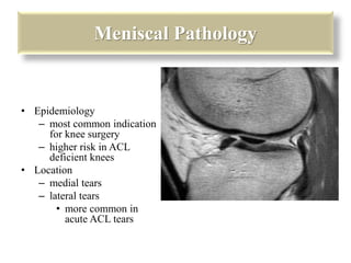 Meniscal Pathology 
• Epidemiology 
– most common indication 
for knee surgery 
– higher risk in ACL 
deficient knees 
• Location 
– medial tears 
– lateral tears 
• more common in 
acute ACL tears 
 