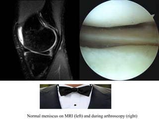 Normal meniscus on MRI (left) and during arthroscopy (right) 
 
