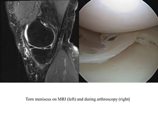 Torn meniscus on MRI (left) and during arthroscopy (right) 
 