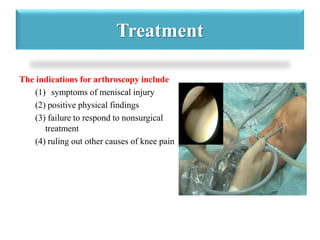 Treatment 
The indications for arthroscopy include 
(1) symptoms of meniscal injury 
(2) positive physical findings 
(3) failure to respond to nonsurgical 
treatment 
(4) ruling out other causes of knee pain 
 