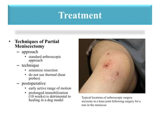 Treatment 
• Techniques of Partial 
Meniscectomy 
– approach 
• standard arthroscopic 
approach 
– technique 
• minimize resection 
• do not use thermal (heat 
probes) 
– postoperative 
• early active range of motion 
• prolonged immobilization 
(10 weeks) is detrimental to 
healing in a dog model 
Typical locations of arthroscopic surgery 
incisions in a knee joint following surgery for a 
tear in the meniscus 
 