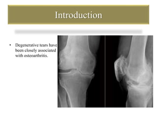 Introduction 
• Degenerative tears have 
been closely associated 
with osteoarthritis. 
 
