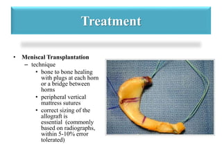 Treatment 
• Meniscal Transplantation 
– technique 
• bone to bone healing 
with plugs at each horn 
or a bridge between 
horns 
• peripheral vertical 
mattress sutures 
• correct sizing of the 
allograft is 
essential (commonly 
based on radiographs, 
within 5-10% error 
tolerated) 
 