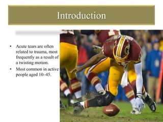 Introduction 
• Acute tears are often 
related to trauma, most 
frequently as a result of 
a twisting motion. 
• Most common in active 
people aged 10–45. 
 