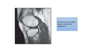 Normal meniscus sagittal
image—the bow-tie
appearance
 