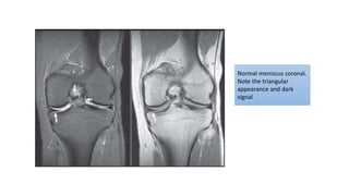 Normal meniscus coronal.
Note the triangular
appearance and dark
signal
 