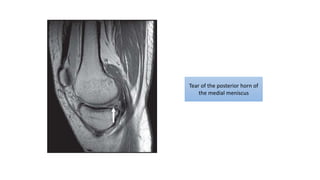 Tear of the posterior horn of
the medial meniscus
 