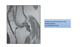 Displaced bucket handle tear with
double posterior
cruciate ligament sign
 