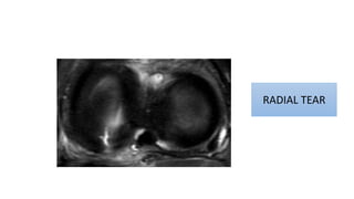 RADIAL TEAR
 