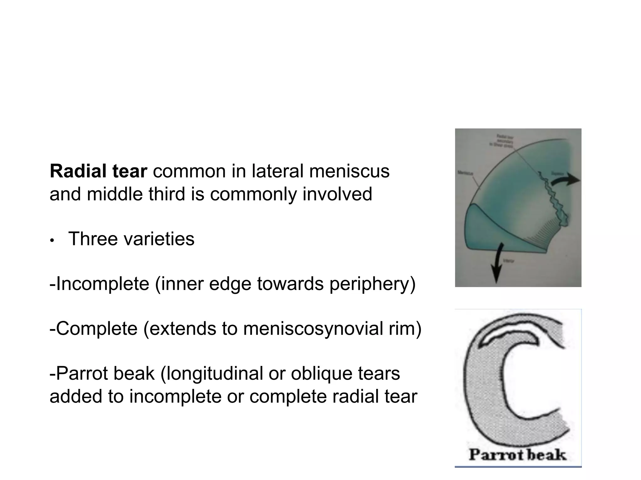 Meniscus Inner Rim Meniscal injury | PPTX