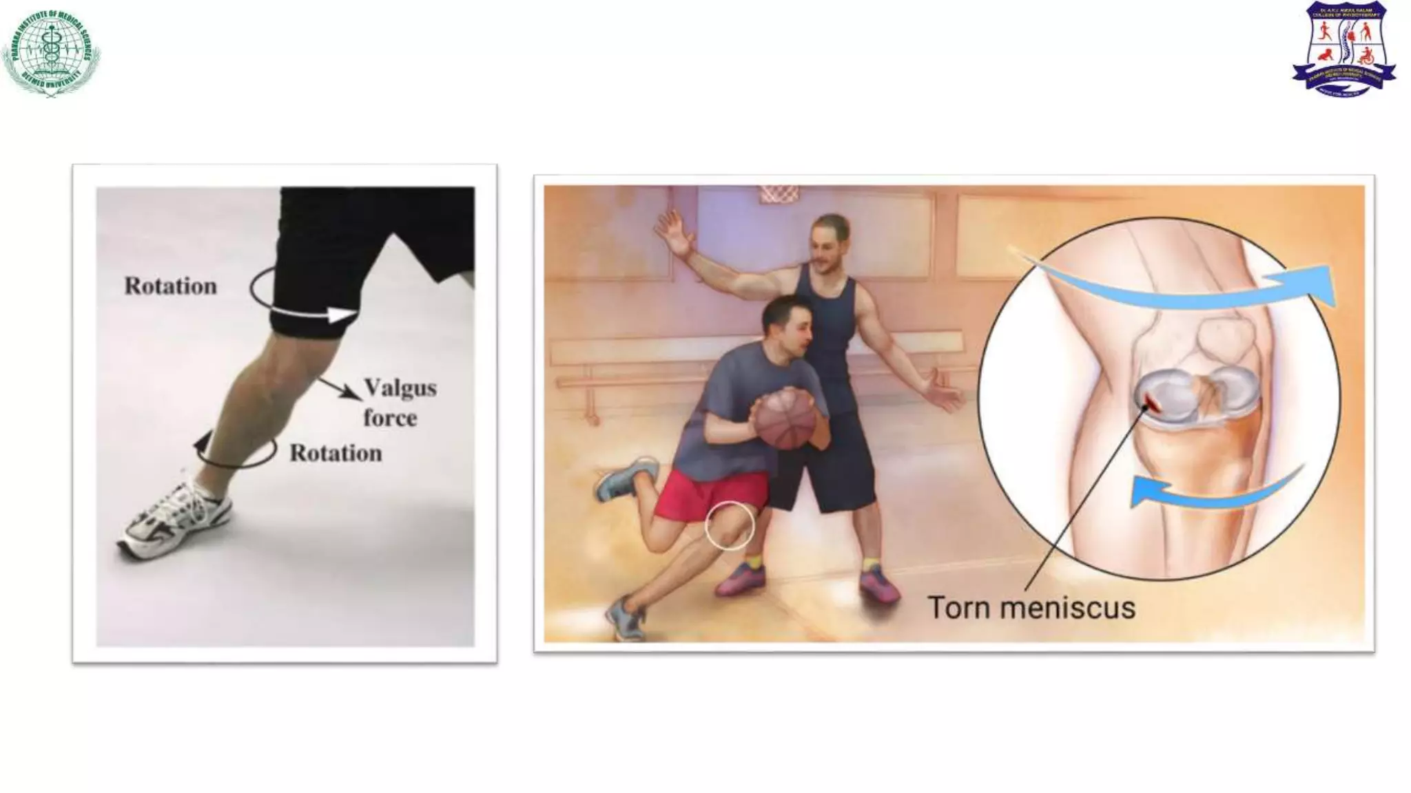 Meniscal injuries and physiotherapy management | PPTX