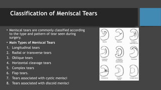 Comprehensive Overview of Meniscal, MCL, and LCL Tears: Anatomy, Injury ...
