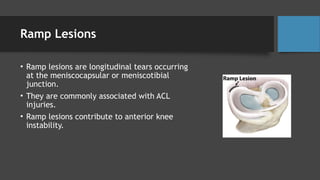Trephination Ramp Lesion Comprehensive Overview of Meniscal, MCL, and LCL Tears: Anatomy, Injury ...