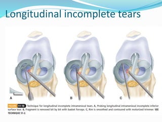 Meniscal pathologies and cartilage injuries | PPTX
