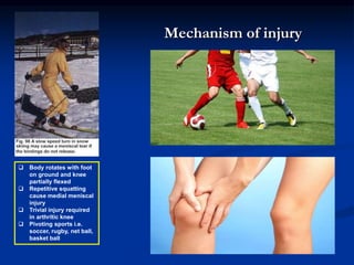 Mechanism of injury 
 Body rotates with foot 
on ground and knee 
partially flexed 
 Repetitive squatting 
cause medial meniscal 
injury 
 Trivial injury required 
in arthritic knee 
 Pivoting sports i.e. 
soccer, rugby, net ball, 
basket ball 
 