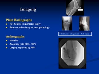 Imaging 
Plain Radiographs 
 Not helpful in meniscal injury 
 Rule out other bony or joint pathology 
Arthrography 
 Invasive 
 Accuracy rate 60% - 90% 
 Largely replaced by MRI 
Tibial tunnel enlargement – ACL injury 
 
