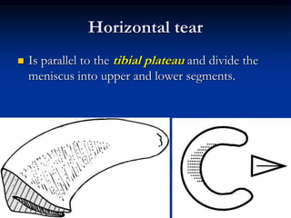 Horizontal tear 
 Is parallel to the tibial plateau and divide the 
meniscus into upper and lower segments. 
 