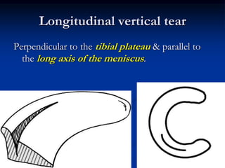 Longitudinal vertical tear 
Perpendicular to the tibial plateau & parallel to 
the long axis of the meniscus. 
 