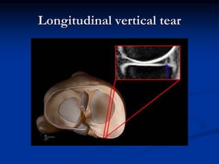 Longitudinal vertical tear 
 
