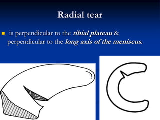 Radial tear 
 is perpendicular to the tibial plateau & 
perpendicular to the long axis of the meniscus. 
 