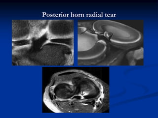 Posterior horn radial tear 
 