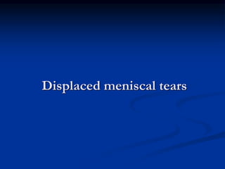 Displaced meniscal tears 
 