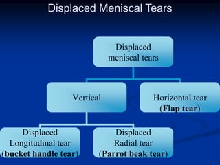 Displaced Meniscal Tears 
Displaced 
meniscal tears 
Vertical Horizontal tear 
(Flap tear) 
Displaced 
Longitudinal tear 
(bucket handle tear) 
Displaced 
Radial tear 
(Parrot beak tear) 
 