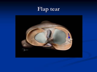 Flap tear 
 