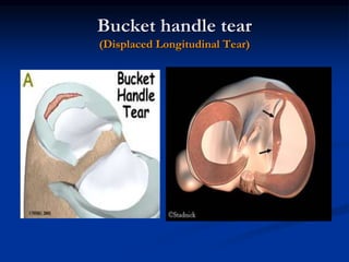 Bucket handle tear 
(Displaced Longitudinal Tear) 
 