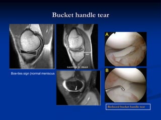 Bucket handle tear 
Reduced bucket handle tear 
Boe-ties sign (normal meniscus 
 