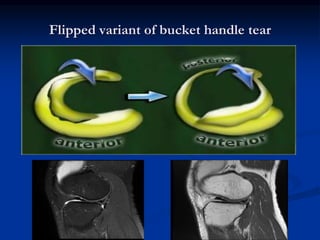 Flipped variant of bucket handle tear 
 