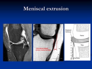 Meniscal extrusion 
 