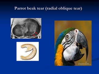 Parrot beak tear (radial oblique tear) 
 