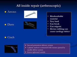 All inside repair (arthroscopic) 
 Arrows 
 Darts 
 Cinch 
• Bioabsorbable 
material 
• Very hard 
• Can break 
• Can migrate 
• Device rubbing can 
cause cartilage defect 
 Second generation delivery system 
 2 plastic anchors connected with sutures passed by 
needle deliver system 
 Knots tightened outside 
