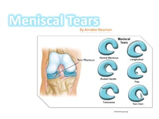 Meniscal Tears
           By Anndee Neuman




                              Orthoinfo.aaos.org
 