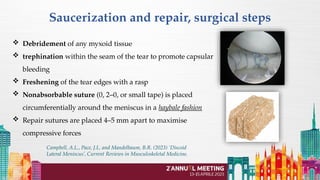 menisco discoide PPT by Russo e Cortina 2024 | PPTX | Death, Injury, or ...