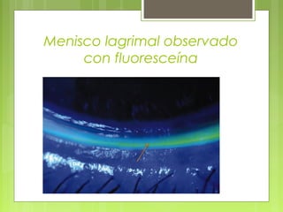 Menisco lagrimal observado
con fluoresceína
 