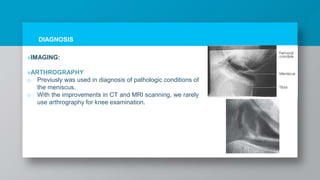 DIAGNOSIS
»IMAGING:
»ARTHROGRAPHY
o Previusly was used in diagnosis of pathologic conditions of
the meniscus.
o With the improvements in CT and MRI scanning, we rarely
use arthrography for knee examination.
 