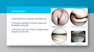 ARTHROSCOPY
»Gold standard for diagnosis and treatment
»Thorough inspection of menisci, ligaments
&cartilage is possible
»Full extent ,type, site of tears & degenerative
changes can be seen.
 