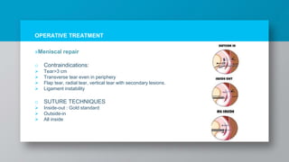 OPERATIVE TREATMENT
»Meniscal repair
o Contraindications:
 Tear>3 cm
 Transverse tear even in periphery
 Flap tear, radial tear, vertical tear with secondary lesions.
 Ligament instability
o SUTURE TECHNIQUES
 Inside-out : Gold standard
 Outside-in
 All inside
 