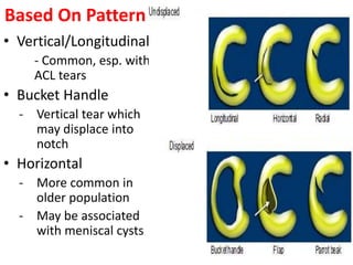 Based On Pattern
• Vertical/Longitudinal
- Common, esp. with
ACL tears
• Bucket Handle
- Vertical tear which
may displace into
notch
• Horizontal
- More common in
older population
- May be associated
with meniscal cysts
 