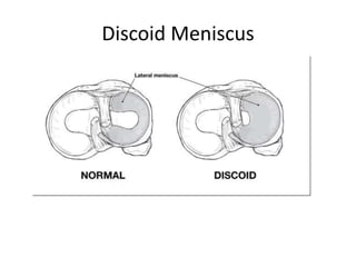 Discoid Meniscus
 