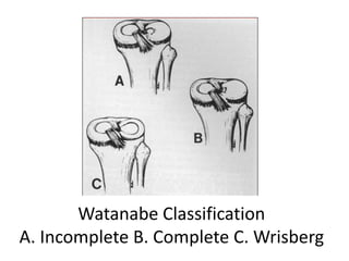 Watanabe Classification
A. Incomplete B. Complete C. Wrisberg
 