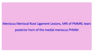 Meniscus Meniscal Root Ligament Lesions, MRI of PMMRL tears
posterior horn of the medial meniscus PHMM
 